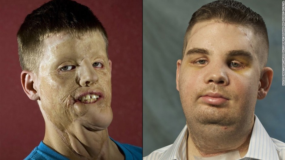Mitch Hunter fue la segunda persona en EE.UU. en recibir un trasplante de rostro.