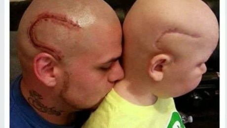 Padre se tatúa en la cabeza la cicatriz de su hijo para apoyarlo en su  lucha contra el cáncer | CNN