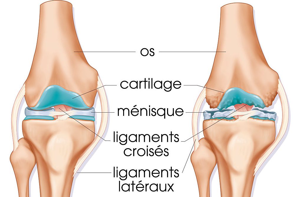 Cómo curar la artrosis de rodilla