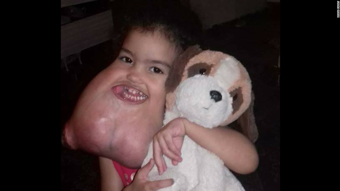 Los médicos calculan que el tumor facial de Melyssa pesaba 5 libras (unos 2 kilos medio).