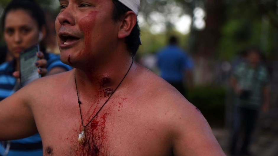 A demonstrator, wounded during clashes with riot police agents, takes part in a protest against the approval of a constitutional amendment for presidential reelection outside Congress in Asuncion, on March 31, 2017. Ruling Colorado party senators and their allies, in a so-called "parallel Senate", unexpectedly approved an amendment Friday that would allow President Horacio Cartes to run for reelection in 2018, triggering protests that led to clashes between opposition demonstrators and the police. / AFP PHOTO / NORBERTO DUARTE (Photo credit should read NORBERTO DUARTE/AFP/Getty Images)