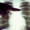 #SaludExpress: El cáncer de pulmón en no fumadores