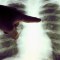 #SaludExpress: ¿Cómo ha evolucionado el cáncer de pulmón?