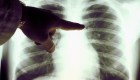 Giselle Guerra: "En Estados Unidos existen muchos pacientes con fibrosis pulmonar"