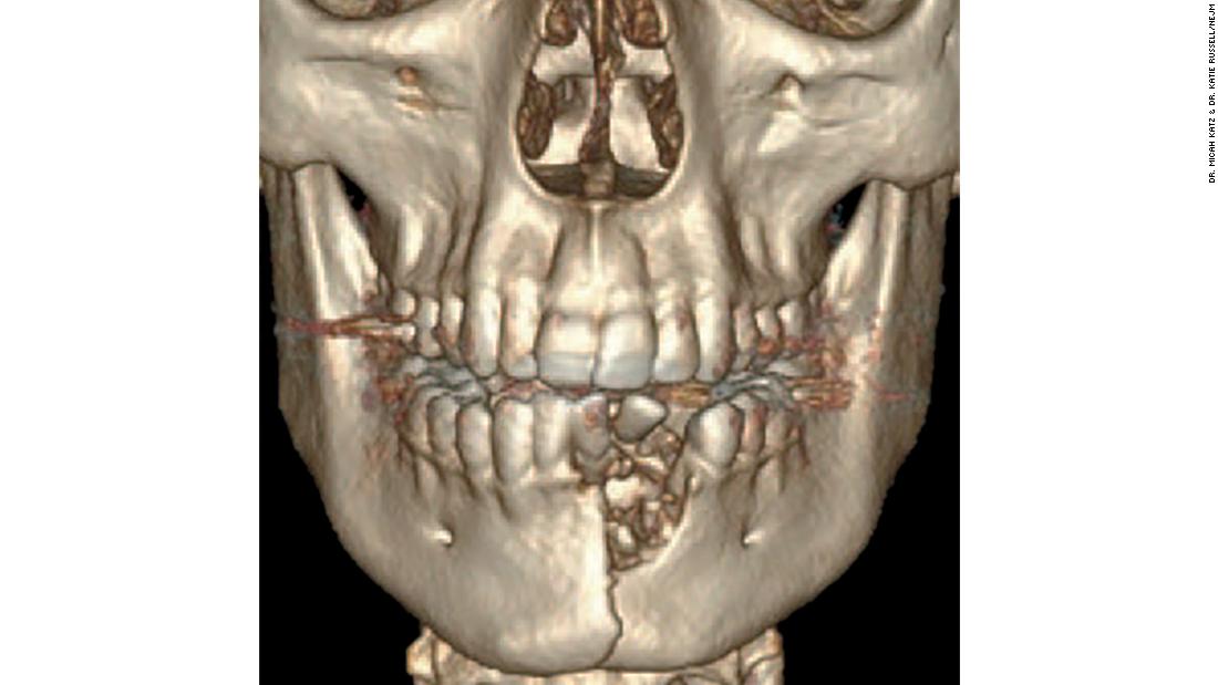 La radiografía del joven de 17 años que muestra su mandíbula destrozada y los dientes desplazados. 