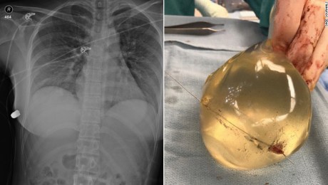 El implante de seno de una mujer desvió una bala y le salvó la vida | CNN
