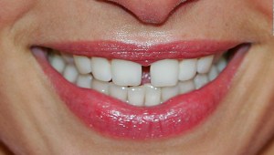 La relación entre los dientes partidos y el covid-19