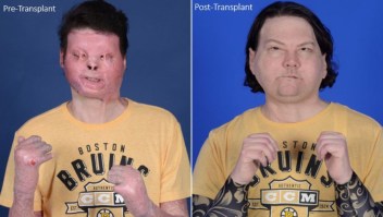 trasplante de rostro y manos