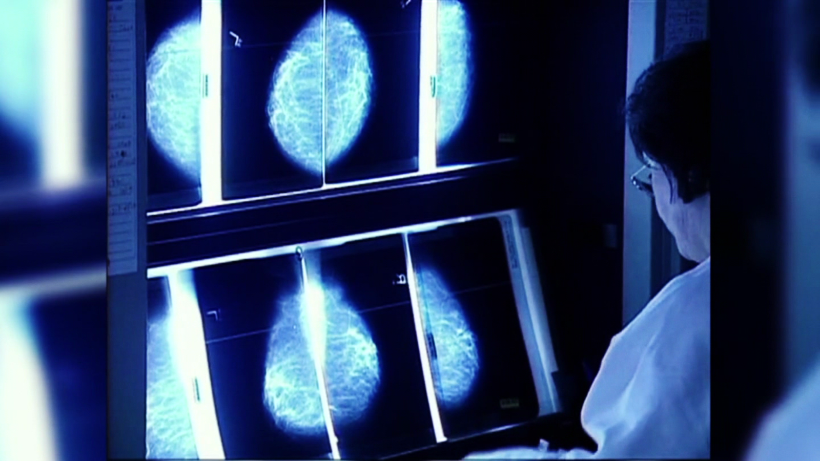 Breast Cancer in Argentina: Early Detection Remains Crucial, Scientists Say |  Video