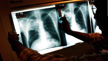 Los países más afectados por la tuberculosis en el mundo