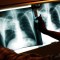 Los países más afectados por la tuberculosis en el mundo