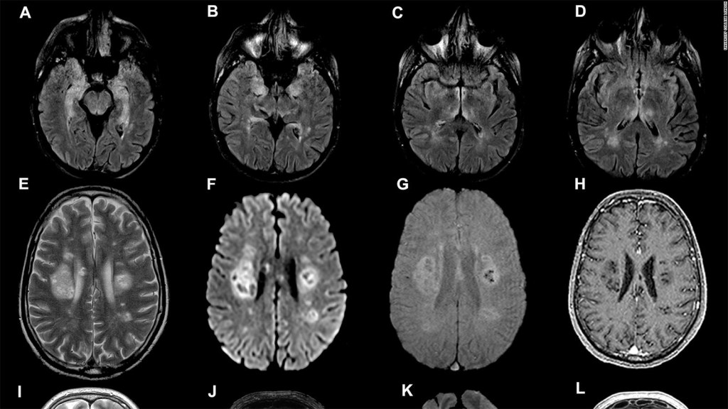 Would covid-19 affect the brain?  Study indicates yes