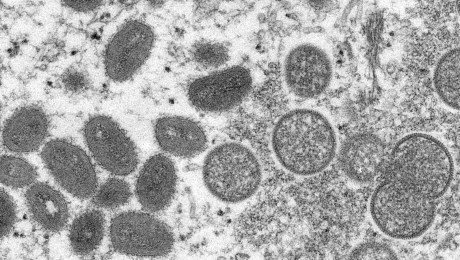 OMS: Hay casi 200 casos confirmados de viruela del mono