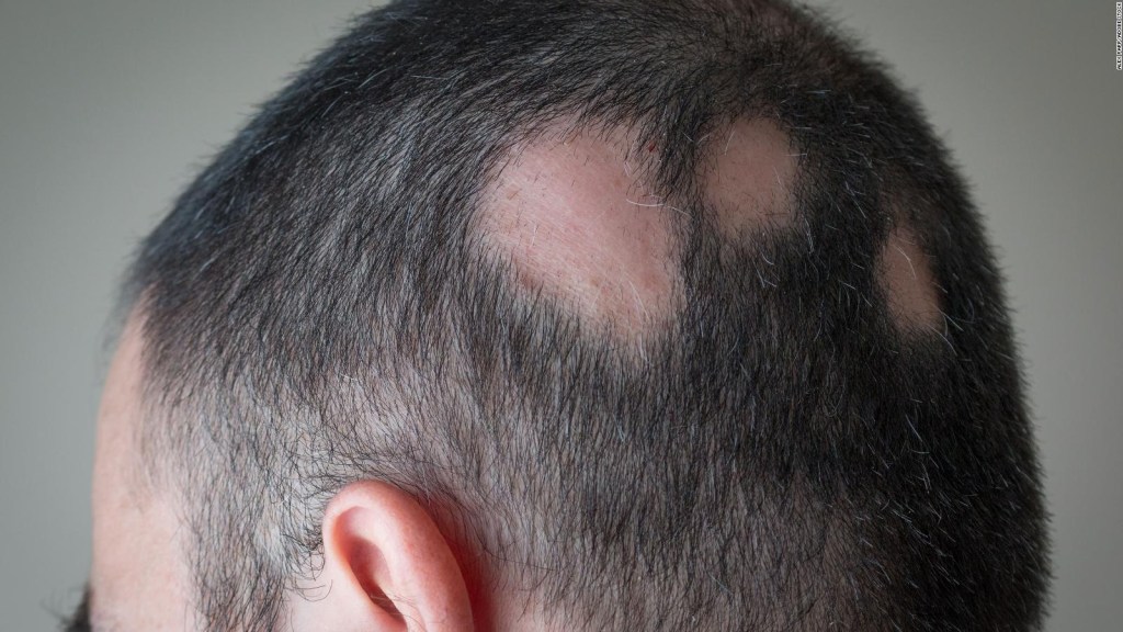 Baldness can be an effective remedy