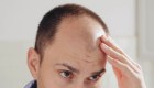 What do we know about the drug that was approved by the FDA against alopecia?