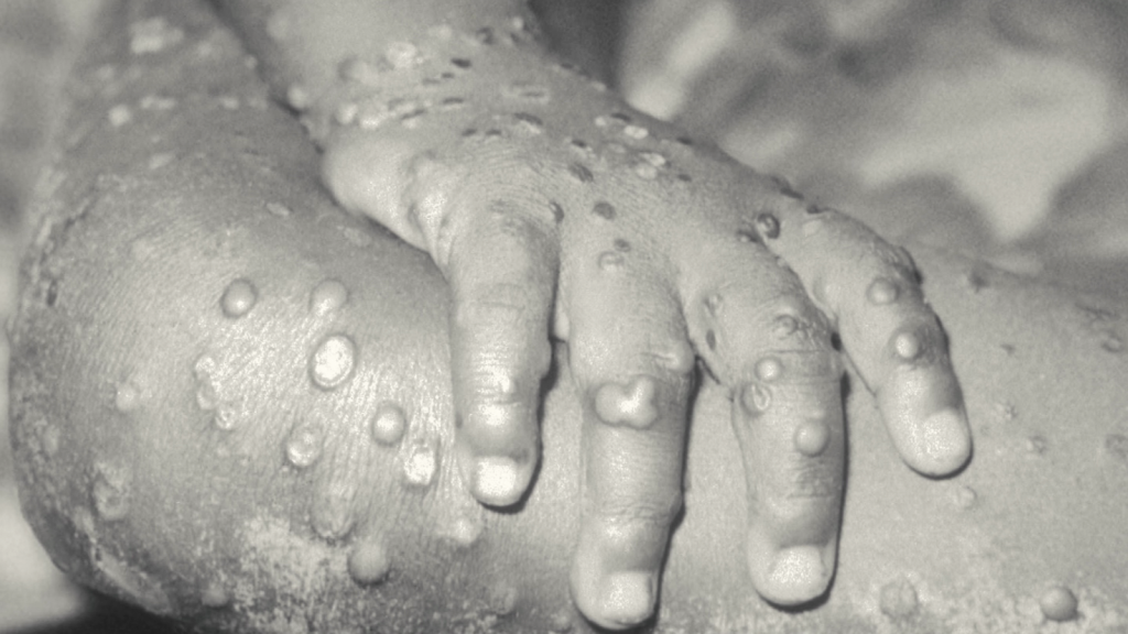 US records rise in monkeypox cases