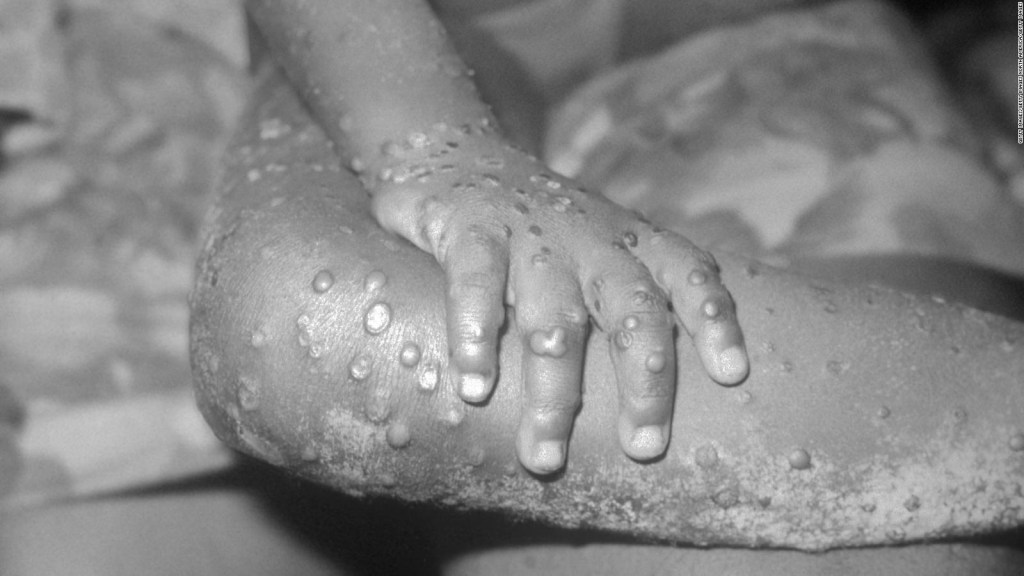 US records cases of monkeypox in children