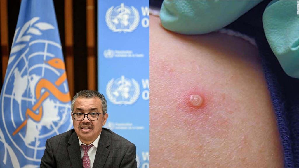 What does it mean that the WHO declares monkeypox an emergency?