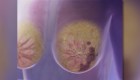 Estudio: pacientes con cáncer de mama podrían saltarse la cirugía