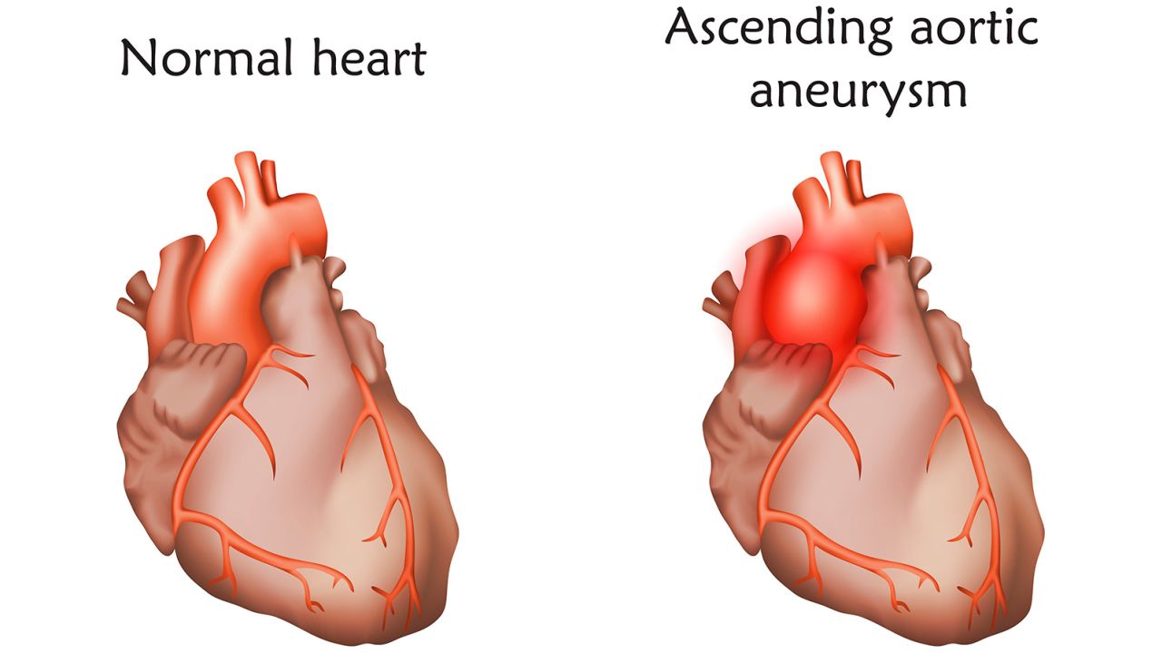 Aneurisma aortico 