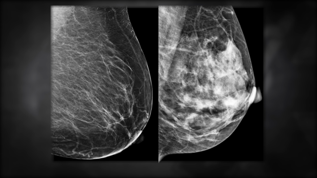 Mamografías 3D, la mejor prueba para detectar cáncer de seno