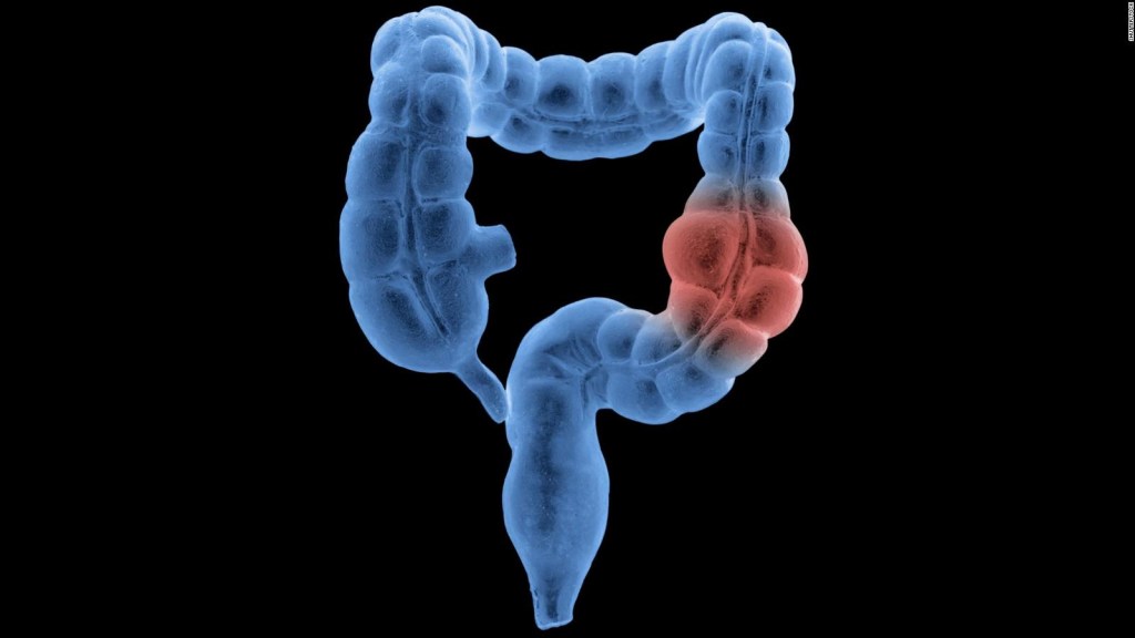 La importancia de una colonoscopia para prevenir el cáncer de colon