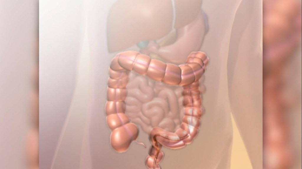 Why do cases of colorectal cancer increase in young people and how to prevent it?
