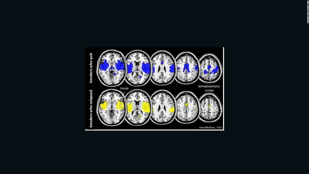 ¿Qué produce la degeneración cerebral CTE?
