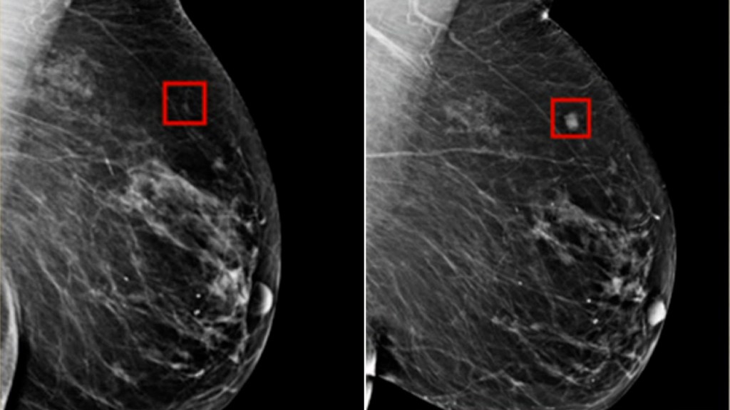 Vacuna contra el cáncer de mama arroja resultados 'prometedores'