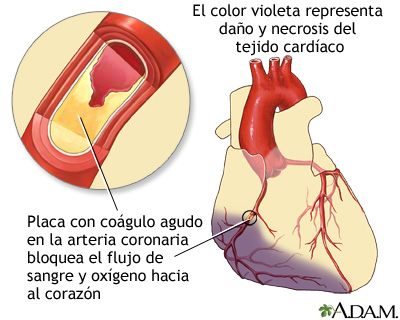 La formación de placa en las arterias coronarias se da en personas que padecen enfermedades del corazón, entre las que se encuentra la enfermedad de las arterias coronarias, que también lleva el nombre de arteriopatía cardíaca. Al romperse la placa en las arterias, se forma un coágulo, el cual puede obstruir la circulación de sangre al corazón y provocar un infarto. (Imagen: medlineplus.gov)