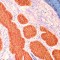 Cáncer de células basales, un tipo de cáncer de piel, visto en una micrografía óptica. (Crédito: Steve Gschmeissner/Marca X/Getty Images)
