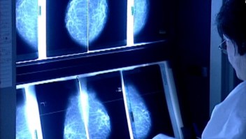Un estudio alerta por el sobrediagnóstico de cáncer de seno en mujeres mayores
