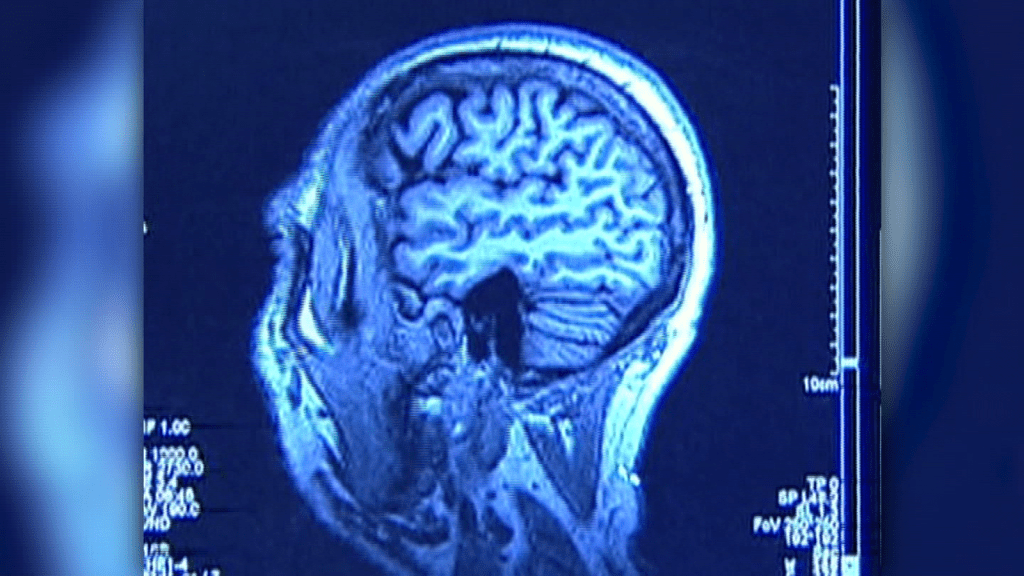 Estudio encuentra signos tempranos de trastorno en cerebros de atletas