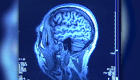 Estudio encuentra signos tempranos de trastorno en cerebros de atletas