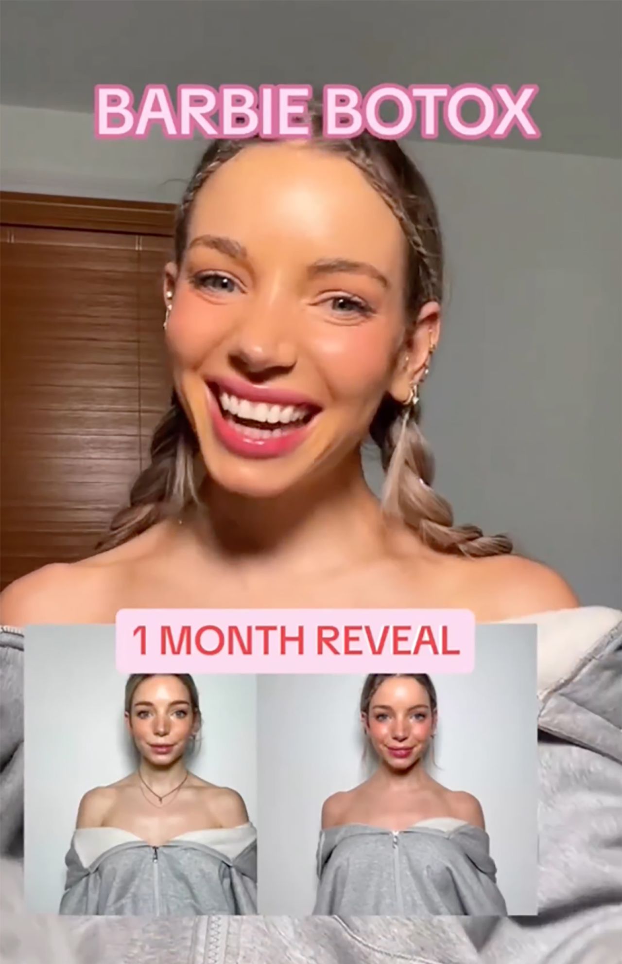 Isabelle Lux compartió en las redes sociales los resultados de su tratamiento con Botox en el trapecio. (De @isabelle.lux_/Instagram)