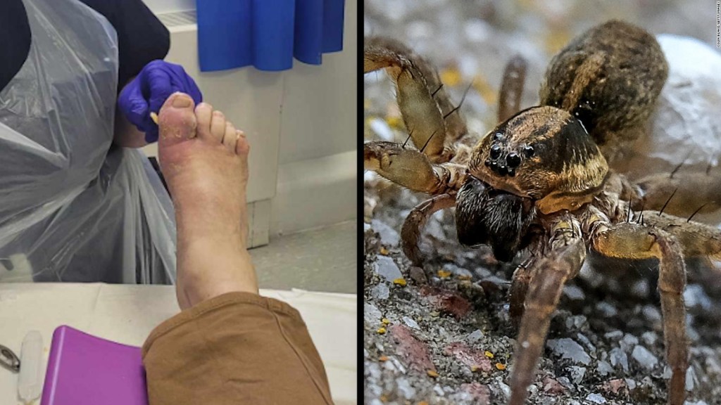 Hombre afirma que una araña puso huevos en su dedo del pie