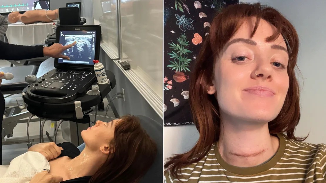 Nella foto a sinistra, Sally Rohan guarda l'ecografia della sua tiroide.  La foto a destra mostra la sua cicatrice chirurgica dopo la rimozione della tiroide.  (Foto: Sally Rohan).