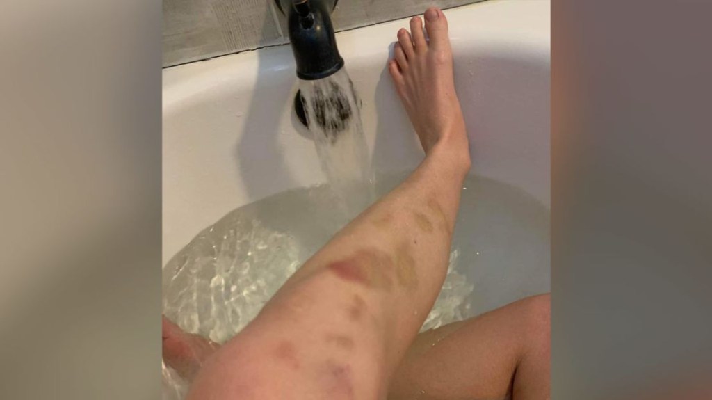 According to her father, Michael Kuch, Adrianna Kuch suffered bruises after being attacked at school.  (Image courtesy of Michael Kuch)