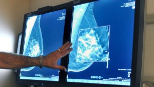 cancer mamografia examen