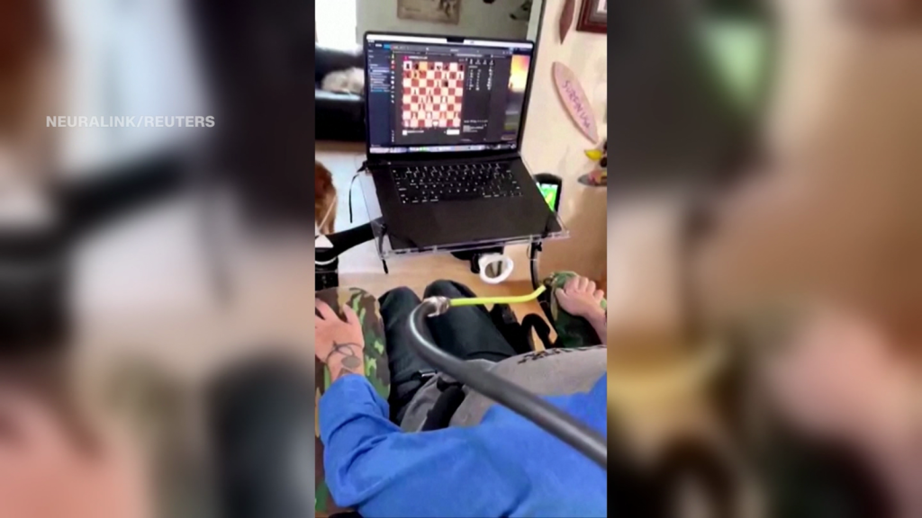 Paciente con chip de Neuralink juega al ajedrez en línea sin sus manos