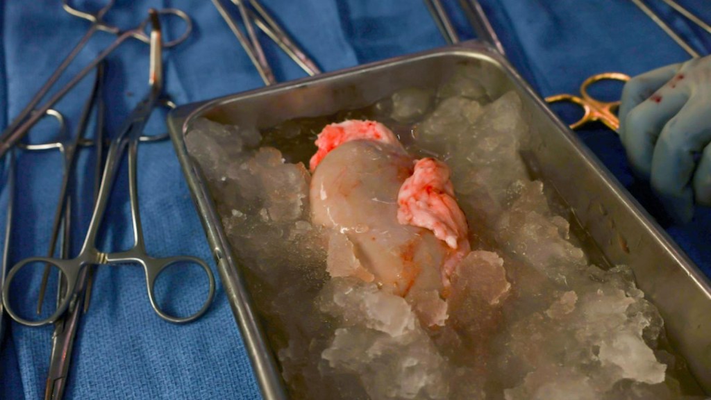 Exitoso trasplante de riñón de cerdo a un humano vivo