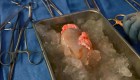 Exitoso trasplante de riñón de cerdo a un humano vivo