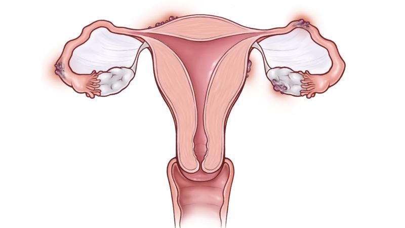 What is endometriosis, its symptoms and treatment?
