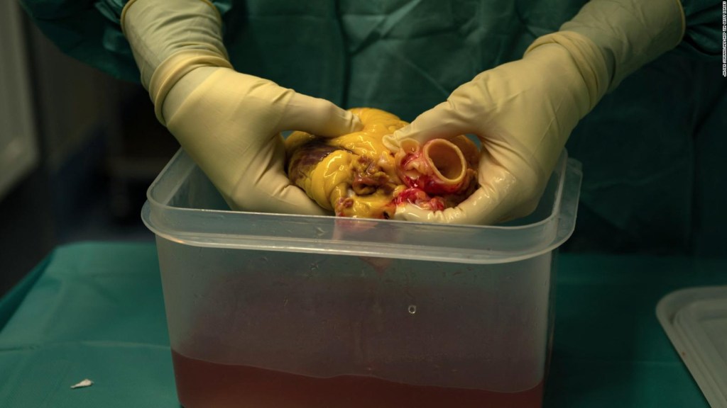 Realizan con éxito primer trasplante de bomba cardiaca y riñón de cerdo