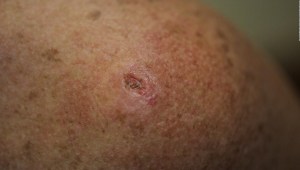 Lo mitos alrededor del cáncer de piel, causas y afectaciones