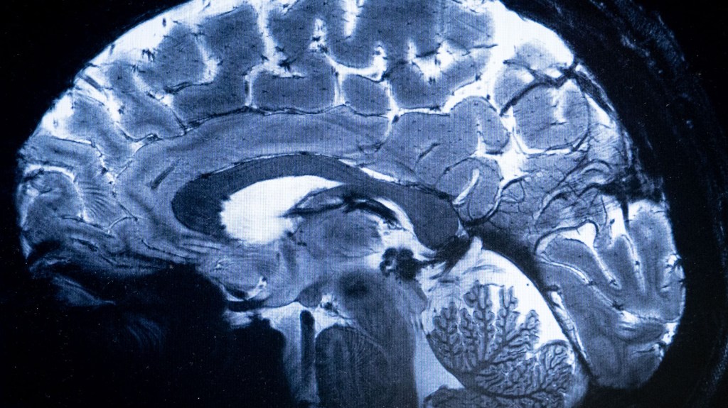 Conozca los síntomas y factores de riesgo del aneurisma cerebral