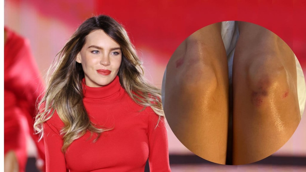 Belinda comparte las heridas que le dejó la caída que tuvo en una pasarela en París